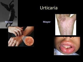 Urticaria
Menor Mayor
 