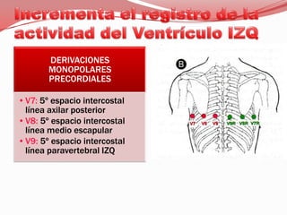 Incrementa el registro de la actividad del Ventrículo IZQ
