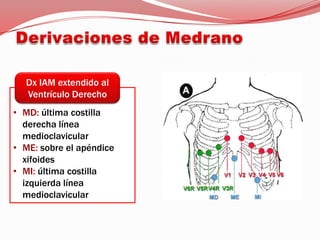Derivaciones de MedranoDx IAM extendido al Ventrículo DerechoMD: última costilla derecha línea medioclavicular