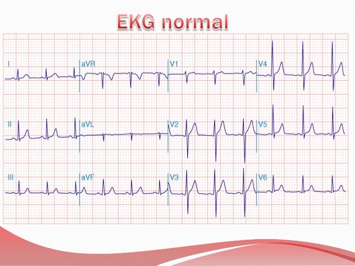 schamroth ecg pdf