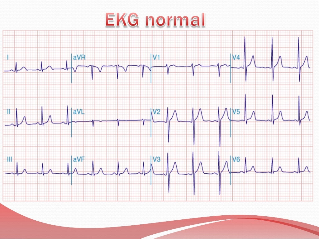 Un Electrocardiograma Conocido Por Sus Siglas Como Ec - vrogue.co