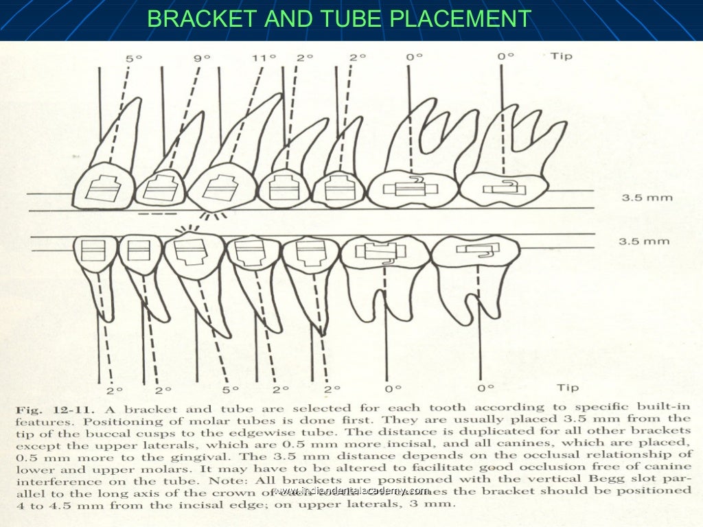 Concepts of orthodontic bracket positioning techniques / fixed orthod…