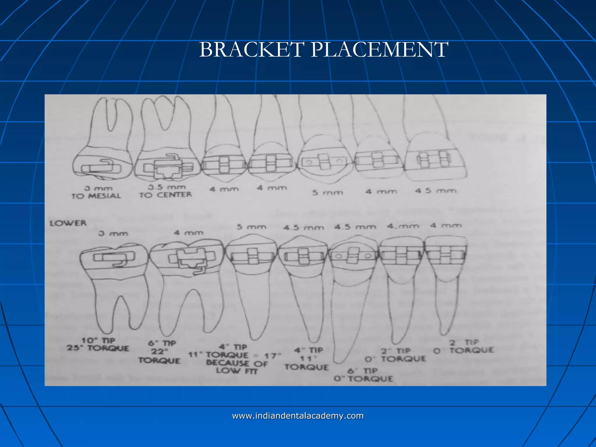 BRACKET PLACEMENT
www.indiandentalacademy.comwww.indiandentalacademy.com
 