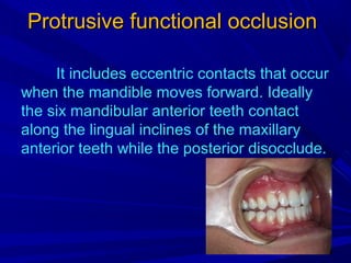 Proclusive Concepts of dental occlusion and importance of six keys of occlusion in ...