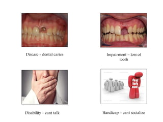 Disease - dental caries Impairment – loss of
tooth
Disability – cant talk Handicap – cant socialize
 