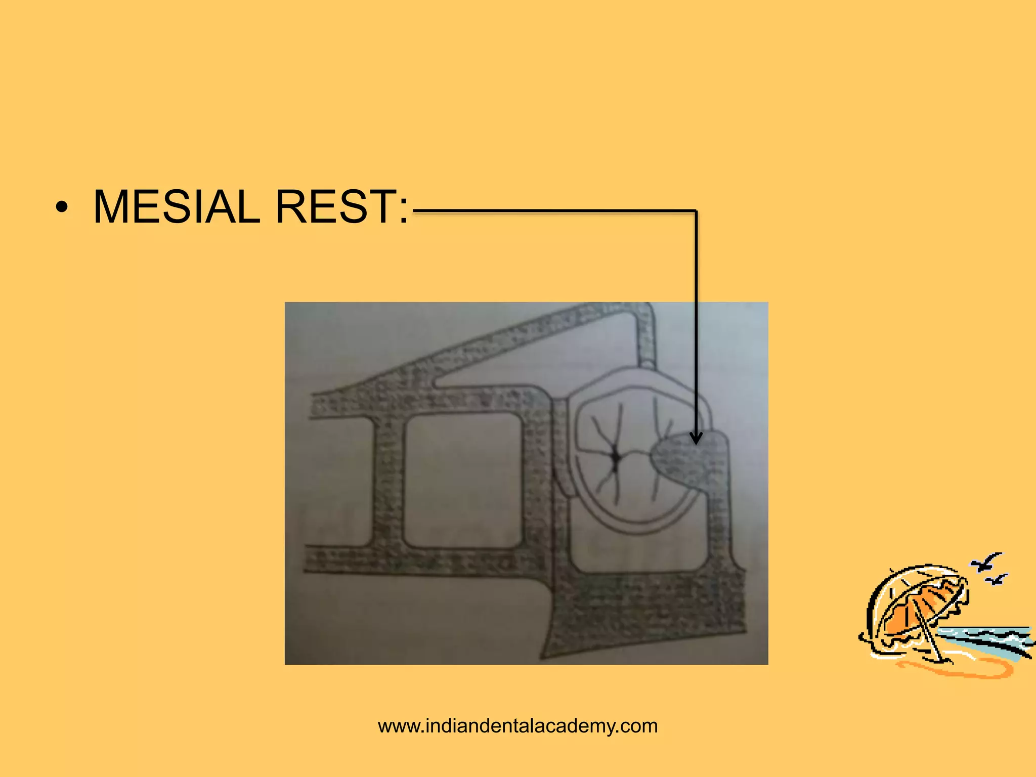 • MESIAL REST:
www.indiandentalacademy.com
 
