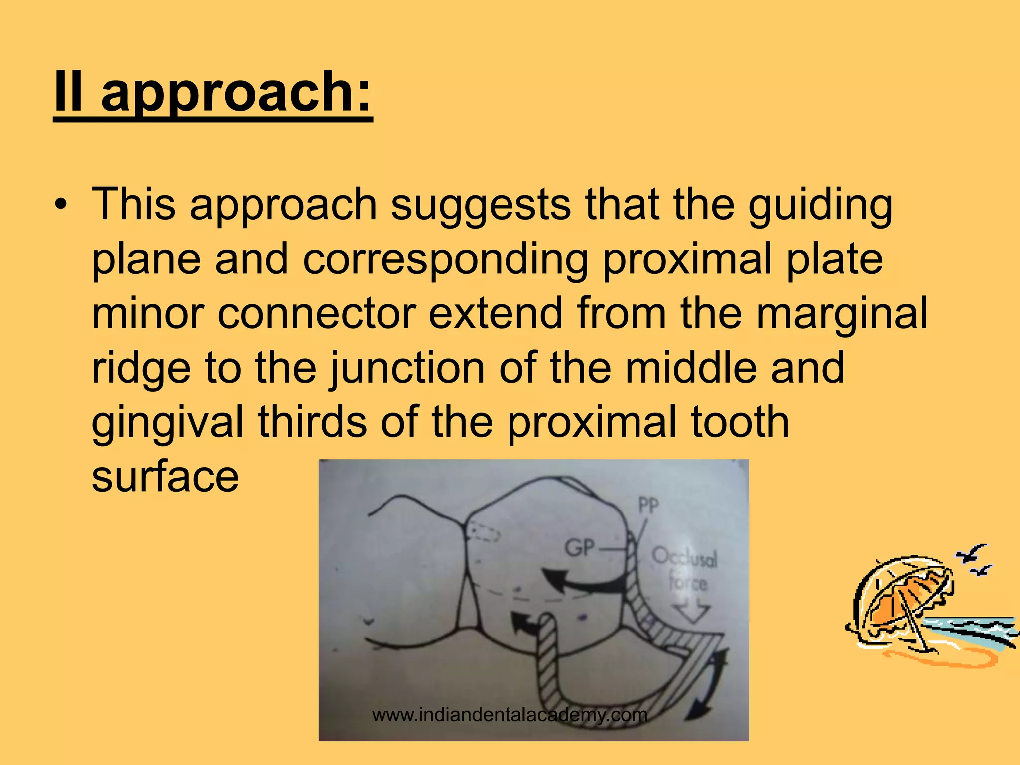 II approach:
• This approach suggests that the guiding
plane and corresponding proximal plate
minor connector extend from the marginal
ridge to the junction of the middle and
gingival thirds of the proximal tooth
surface
www.indiandentalacademy.com
 