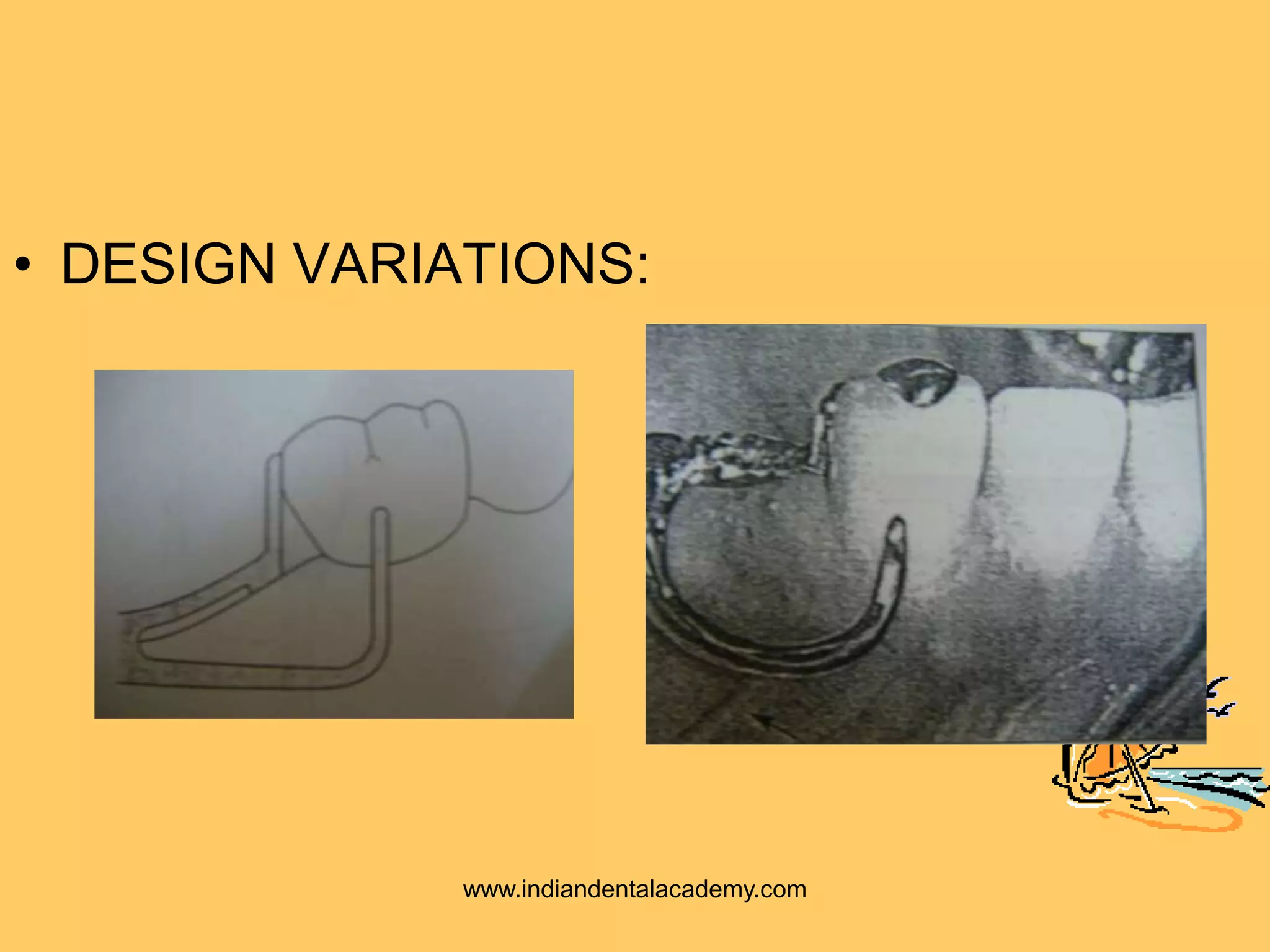 • DESIGN VARIATIONS:
www.indiandentalacademy.com
 