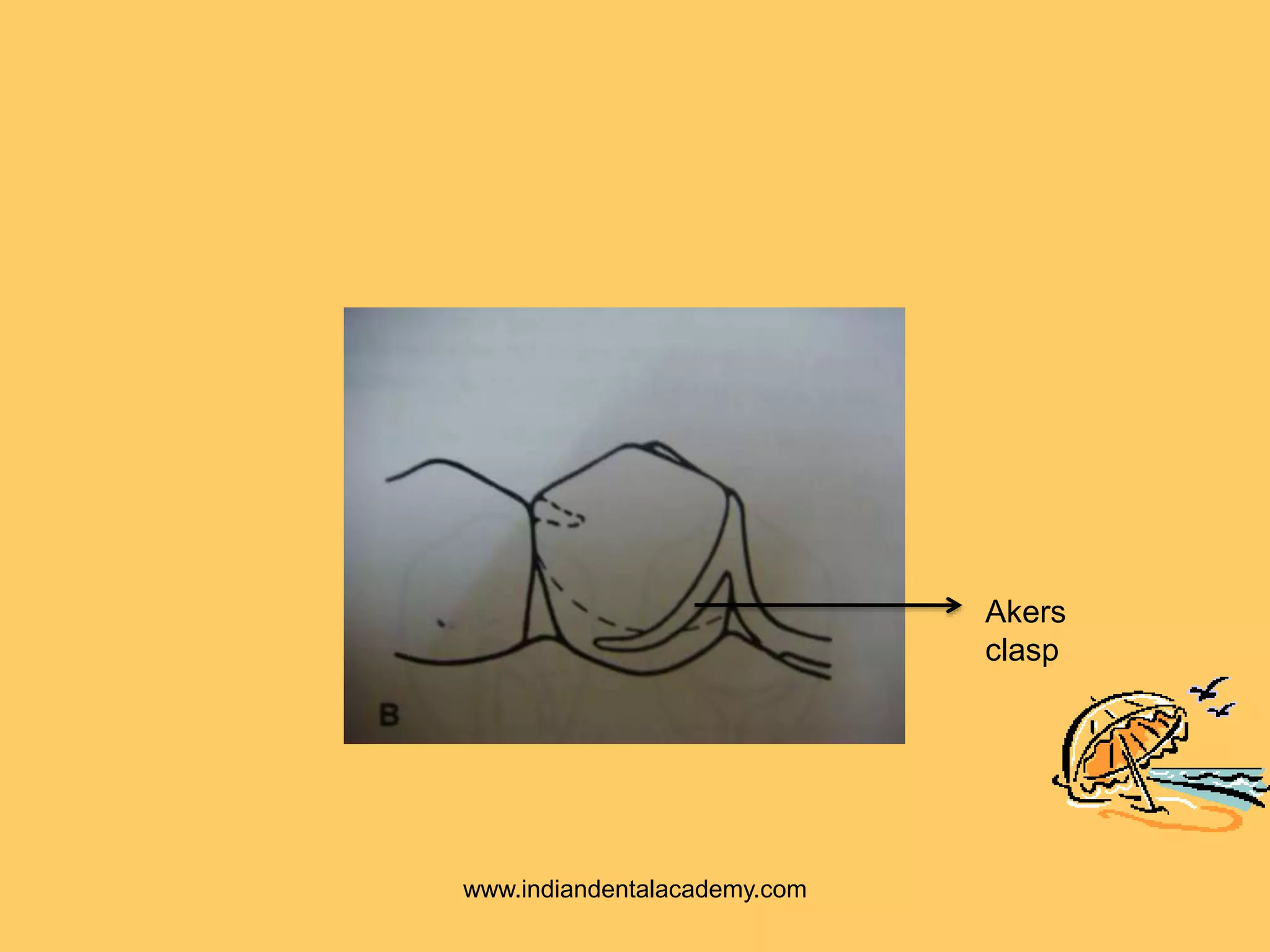 Akers
clasp
www.indiandentalacademy.com
 