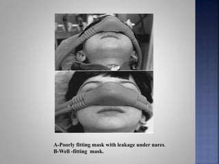 A-Poorly fitting mask with leakage under nares.
B-Well -fitting mask.
 