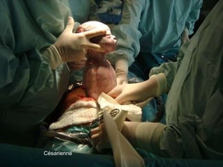 Césarienne 
