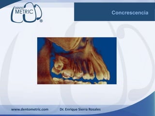 www.dentometric.com Dr. Enrique Sierra Rosales
Concrescencia
 