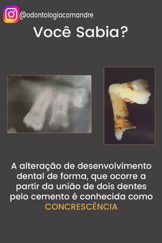 Concrescência e Alterações de Desenvolvimento de Forma - Resumo - Concurso Odontologia.pdf