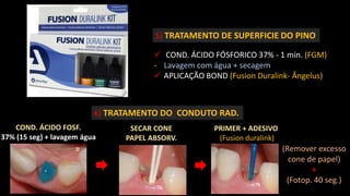 5) TRATAMENTO DE SUPERFICIE DO PINO
 COND. ÁCIDO FÓSFORICO 37% - 1 min. (FGM)
- Lavagem com água + secagem
 APLICAÇÃO BOND (Fusion Duralink- Ângelus)
6) TRATAMENTO DO CONDUTO RAD.
COND. ÁCIDO FOSF.
37% (15 seg) + lavagem água
SECAR CONE
PAPEL ABSORV.
PRIMER + ADESIVO
(Fusion duralink)
(Remover excesso
cone de papel)
+
(Fotop. 40 seg.)
 