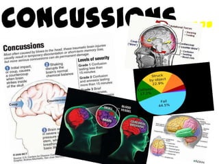 Concussions…..
 