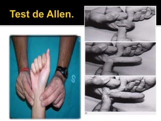    Resultados
     El llenado debe ocurrir
      antes de los 7 segundos.

     Puede haber resultados
      falsos positivos o
      dudosos cuando es
      mayor de 7 segundos
      que indican el flujo pobre
      a través de una arteria.

     Si no hay llenado es
      porque la arteria que
      liberamos esta obstruida.
 