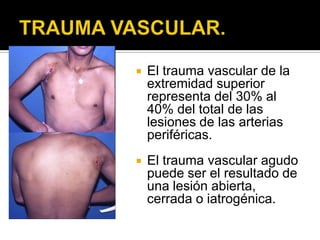    El trauma vascular de la
    extremidad superior
    representa del 30% al
    40% del total de las
    lesiones de las arterias
    periféricas.
   El trauma vascular agudo
    puede ser el resultado de
    una lesión abierta,
    cerrada o iatrogénica.
 