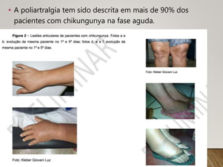• A poliartralgia tem sido descrita em mais de 90% dos
pacientes com chikungunya na fase aguda.
 