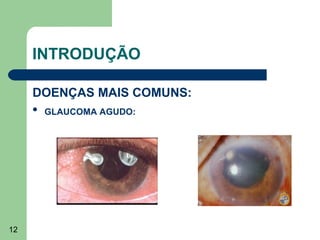 INTRODUÇÃO

     DOENÇAS MAIS COMUNS:
        GLAUCOMA AGUDO:




12
 