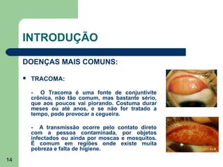 INTRODUÇÃO

     DOENÇAS MAIS COMUNS:

        TRACOMA:

         - O Tracoma é uma fonte de conjuntivite
         crônica, não tão comum, mas bastante sério,
         que aos poucos vai piorando. Costuma durar
         meses ou até anos, e se não for tratado a
         tempo, pode provocar a cegueira.

         - A transmissão ocorre pelo contato direto
         com a pessoa contaminada, por objetos
         infectados ou ainda por moscas e mosquitos.
         É comum em regiões onde existe muita
         pobreza e falta de higiene.
14
 