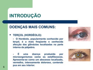 INTRODUÇÃO

    DOENÇAS MAIS COMUNS:

       TERÇOL (HORDÉOLO):
        - O Hordéolo, popularmente conhecido por
        terçol, é a mais freqüente e conhecida
        afecção das glândulas localizadas na parte
        interna da pálpebra.

        -   É   uma      doença   produzida   por
        microorganismos como os estafilococos.
        Apresenta-se como um abscesso localizado,
        vermelho, intensamente doloroso, contendo
        pus em seu interior.
6
 