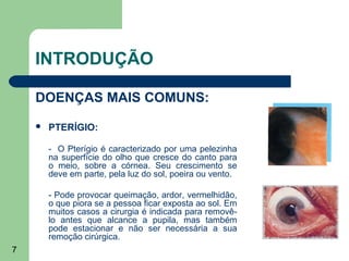 INTRODUÇÃO

    DOENÇAS MAIS COMUNS:
       PTERÍGIO:

        - O Pterígio é caracterizado por uma pelezinha
        na superfície do olho que cresce do canto para
        o meio, sobre a córnea. Seu crescimento se
        deve em parte, pela luz do sol, poeira ou vento.

        - Pode provocar queimação, ardor, vermelhidão,
        o que piora se a pessoa ficar exposta ao sol. Em
        muitos casos a cirurgia é indicada para removê-
        lo antes que alcance a pupila, mas também
        pode estacionar e não ser necessária a sua
        remoção cirúrgica.
7
 
