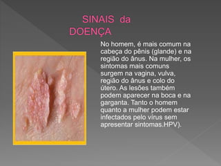 No homem, é mais comum na
cabeça do pênis (glande) e na
região do ânus. Na mulher, os
sintomas mais comuns
surgem na vagina, vulva,
região do ânus e colo do
útero. As lesões também
podem aparecer na boca e na
garganta. Tanto o homem
quanto a mulher podem estar
infectados pelo vírus sem
apresentar sintomas.HPV).
 