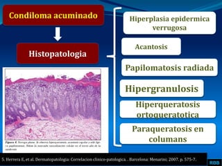 RBB
Condiloma acuminado
Histopatologia
Hiperplasia epidermica
verrugosa
Acantosis
5. Herrera E, et al. Dermatopatologia: Correlacion clinico-patologica. . Barcelona: Menarini; 2007. p. 575-7.
Papilomatosis radiada
Hipergranulosis
Hiperqueratosis
ortoqueratotica
Paraqueratosis en
columans
 