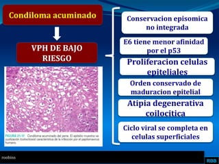 RBB
Condiloma acuminado
VPH DE BAJO
RIESGO
Conservacion episomica
no integrada
E6 tiene menor afinidad
por el p53
roobins
Proliferacion celulas
epiteliales
Orden conservado de
maduracion epitelial
Atipia degenerativa
coilocitica
Ciclo viral se completa en
celulas superficiales
 