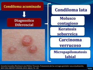 RBB
Condiloma acuminado
Diagnostico
Diferencial
Condiloma lata
Molusco
contagioso
Gerardo González Martínez1, José Núñez Troconis. Tratamiento de las verrugas genitales: una actualización.
REV CHIL OBSTET GINECOL 2015; 80(1): 76 - 83
Keratosis
seborreica
Carcinoma
verrucoso
Micropapilomatosis
labial
 