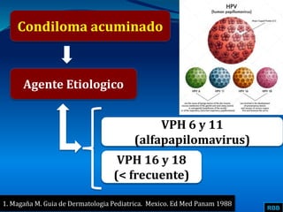 RBB
Condiloma acuminado
Agente Etiologico
VPH 6 y 11
(alfapapilomavirus)
VPH 16 y 18
(< frecuente)
1. Magaña M. Guia de Dermatologia Pediatrica. Mexico. Ed Med Panam 1988
 
