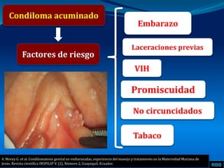 RBB
Condiloma acuminado
Factores de riesgo
Embarazo
Laceraciones previas
4. Morey G. et al. Condilomatosis genital en embarazadas, experiencia del manejo y tratamiento en la Maternidad Mariana de
Jesús. Revista científica INSPILIP V. (2), Número 2, Guayaquil, Ecuador.
VIH
Promiscuidad
No circuncidados
Tabaco
 