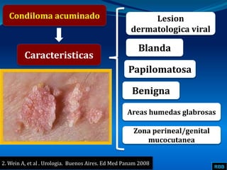RBB
Condiloma acuminado
Caracteristicas
Lesion
dermatologica viral
Blanda
2. Wein A, et al . Urologia. Buenos Aires. Ed Med Panam 2008
Papilomatosa
Benigna
Areas humedas glabrosas
Zona perineal/genital
mucocutanea
 