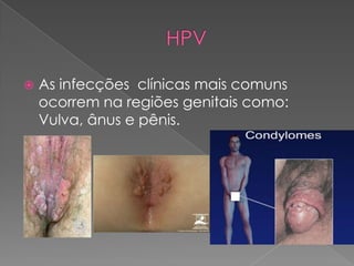    As infecções clínicas mais comuns
    ocorrem na regiões genitais como:
    Vulva, ânus e pênis.
 