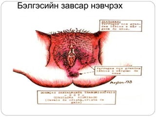 Бэлгэсийн завсар нэвчрэх
 