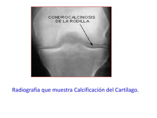 Condrocalcinosis | PPTX