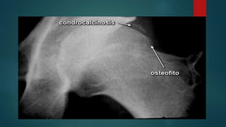 Condrocalcinosis | PPTX