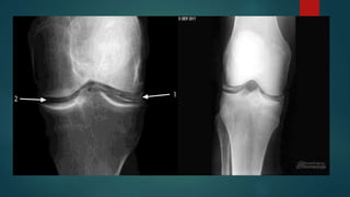 Condrocalcinosis | PPTX