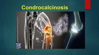 Condrocalcinosis
 