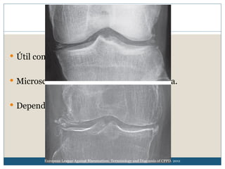 Condrocalcinosis DIAGNOSTICO Y TRATAMIENTO | PPT