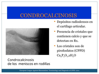 Condrocalcinosis DIAGNOSTICO Y TRATAMIENTO | PPT