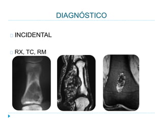 DIAGNÓSTICO
INCIDENTAL
RX, TC, RM