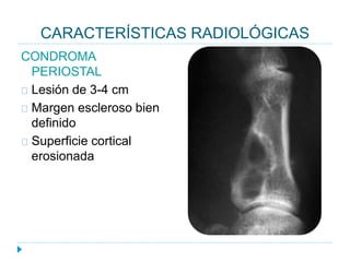 CARACTERÍSTICAS RADIOLÓGICAS
CONDROMA
PERIOSTAL
Lesión de 3-4 cm
Margen escleroso bien
definido
Superficie cortical
erosionada
