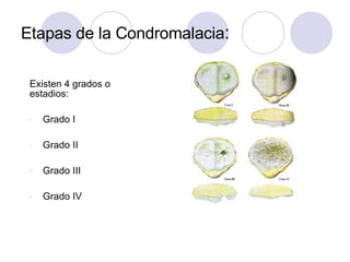 Etapas de la Condromalacia:
Existen 4 grados o
estadios:
v Grado I
v Grado II
v Grado III
v Grado IV
 