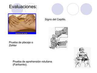 Evaluaciones:
Signo del Cepillo.
Prueba de aprehensión rotuliana
(Fairbanks).
Prueba de placaje o
Zohler
 