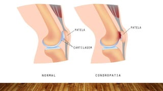 • Como a cartilagem não está ideal em quem tem condromalácia patelar, o joelho
fica instável, causando maior atrito entre ...