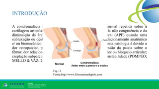 INTRODUÇÃO
A condromalácia é produzida pela ação compressiva anormal repetida sobre a
cartilagem articular. Esta compressão anormal é derivada da não congruência e da
diminuição da área de contato da articulação patelofemural (APF) quando uma
subluxação ou deslocamento patelar for causado por um relacionamento anatômico
e/ ou biomecânico anormal (Ye et al., 2001). Os sintomas nesta patologia é devido a
dor retropatelar, produzida pelos movimentos de compressão da patela sobre o
fêmur, dor relacionada com a contração do quadríceps; rigidez ou bloqueio articular;
creptação subpatelar nos movimentos ativos; e sensação de instabilidade (POMPEO;
MELLO & VAZ, 2012) .
Fig.: 2
Fonte:http://www.fotosantesedepois.com
 