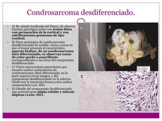 Condrosarcoma desdiferenciado.
 A) Rx simple localizada del fémur: Se observa
fractura patológica sobre una lesión lítica
con permeación de la cortical y con
calcificaciones grumosas de tipo
condral.
 B) Pieza quirúrgica de condrosarcoma
desdiferenciado de costilla. Junto a áreas en
que el tumor presenta el característico
aspecto hialino, de un condrosarcoma
bien diferenciado, se observan zonas
de color pardo o amarillento
correspondientes a las áreas del componente
desdiferenciado.
 C) Visión microscópica panorámica que
muestra ambos componentes de
condrosarcoma: Bien diferenciado, en la
parte superior de la imagen, y del
componente desdiferenciado en la inferior.
Obsérvese la transición brusca entre ambos
componentes (x10, HE).
 D) Detalle del componente desdiferenciado
que presenta gran atipia celular y mitosis
atípicas (x100, HE).
 