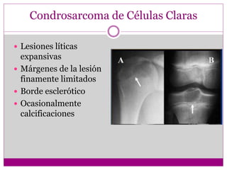 Condrosarcoma de Células Claras
 Lesiones líticas
expansivas
 Márgenes de la lesión
finamente limitados
 Borde esclerótico
 Ocasionalmente
calcificaciones
 