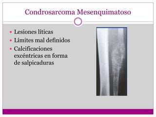 Condrosarcoma Mesenquimatoso
 Lesiones líticas
 Límites mal definidos
 Calcificaciones
excéntricas en forma
de salpicaduras
 